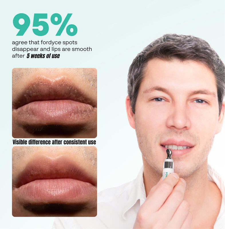 Crema De Labios Abera Abera Fordyce Con Hpr Par... image number null