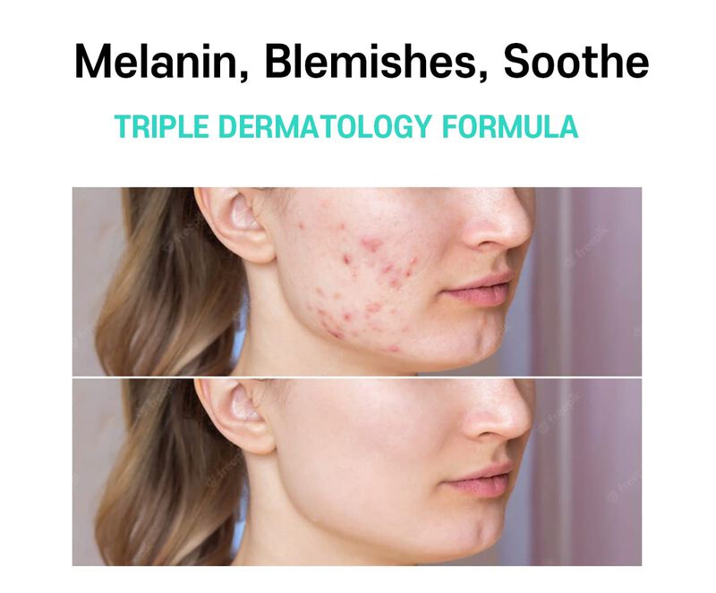 Crema Para Tratamiento De Melasma, Removedor De... image number null