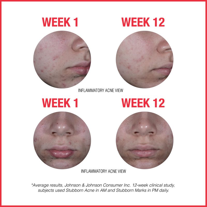 Tratamiento Facial Neutrogena 60ml + 30ml Acn&eacute; image number null