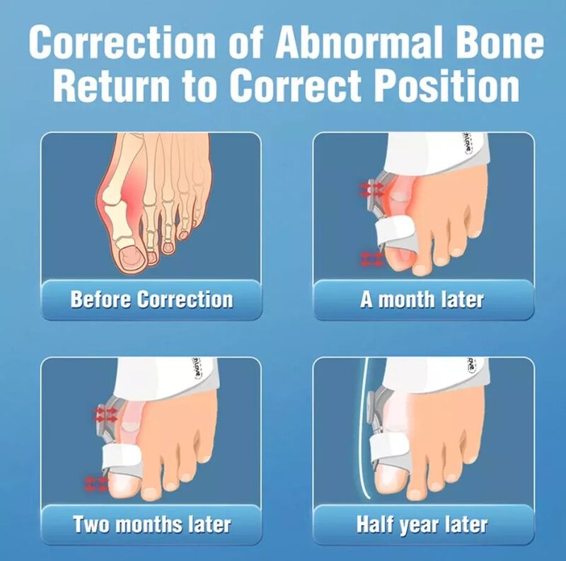 Corrector De Juanetes Sistema Quick-fit: Ajuste... image number null