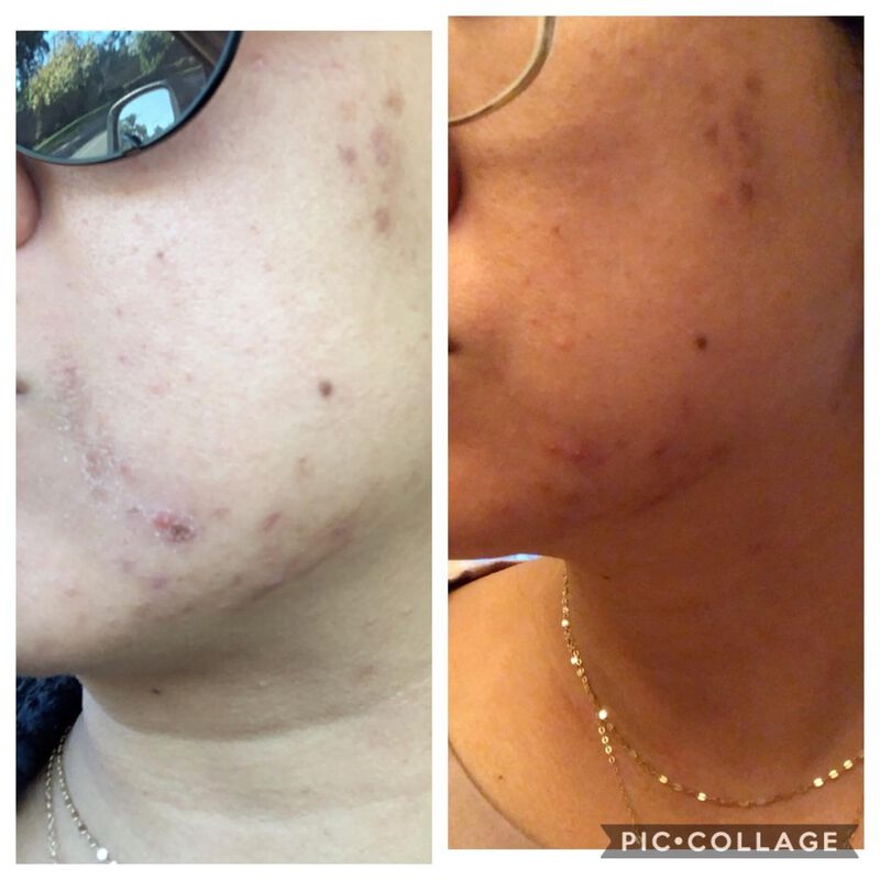 Exfoliante Facial Kiaeva 30 ml 50% TCA image number null