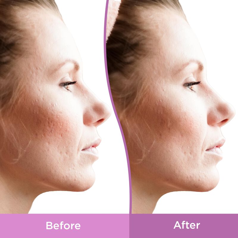 Gel Differin Para Tratamiento Facial De Manchas... image number null