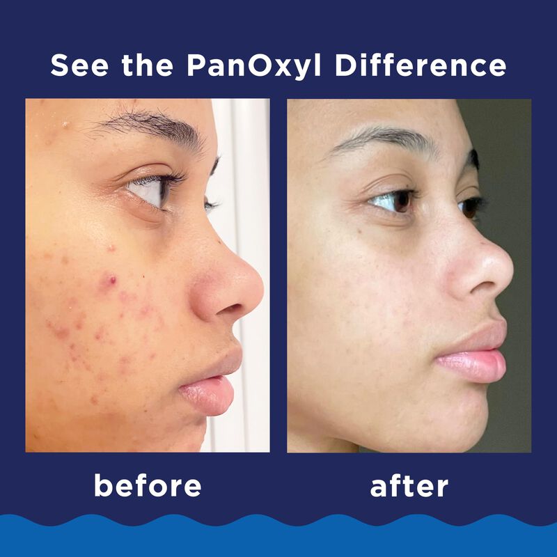 Limpiador Facial Panoxyl Acne Foaming Con Per&oacute;x... image number null