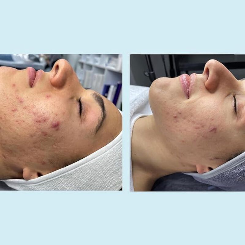 Exfoliante Facial Kiaeva 30 ml 50% TCA image number null