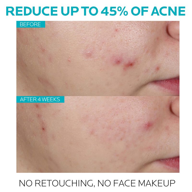 S&eacute;rum Effaclar para Acn&eacute; La Roche-Posay con &Aacute;ci... image number null