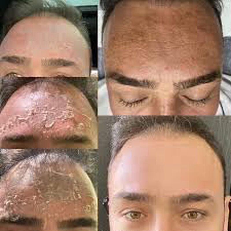 Exfoliante Qu&iacute;mico Tcatherapycare 30ml 50% TCA image number null