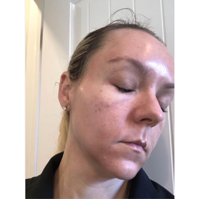 Exfoliante Qu&iacute;mico Tcatherapycare 30ml 50% TCA image number null