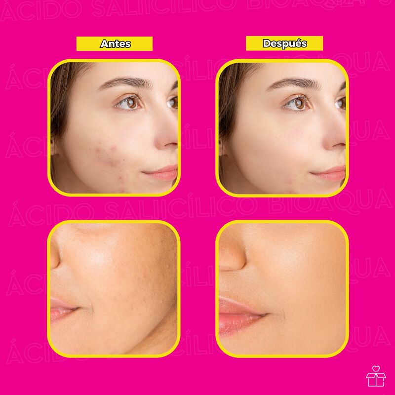 Crema de &Aacute;cido Salic&iacute;lico Anti Acn&eacute; Reduce Gras... image number null