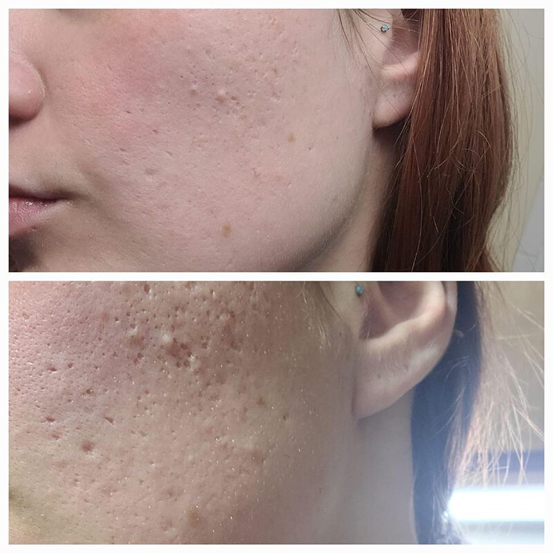 Exfoliante Facial Kiaeva 30 ml 50% TCA image number null